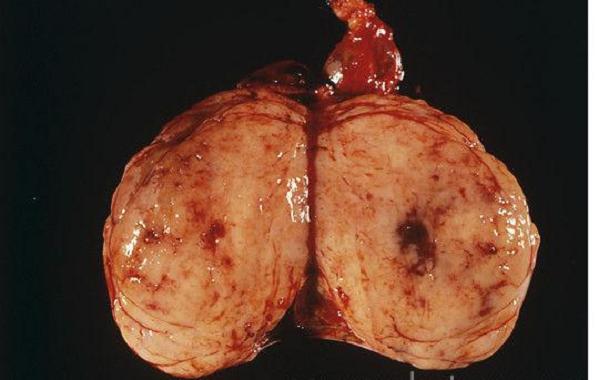 Testicoli tumore